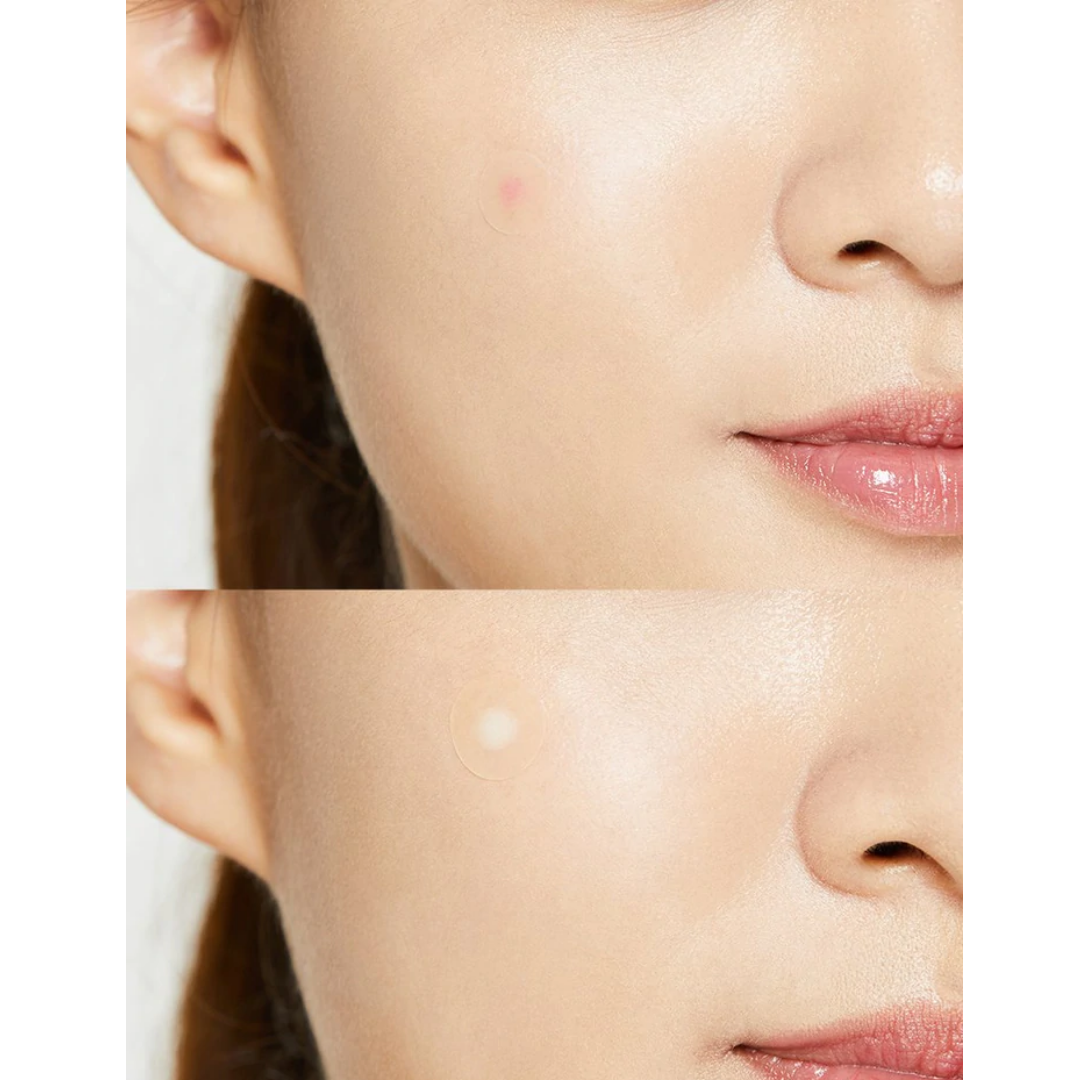 COSRXAcne Pimple Master Patches (24 Patches) - Glowii Beauty